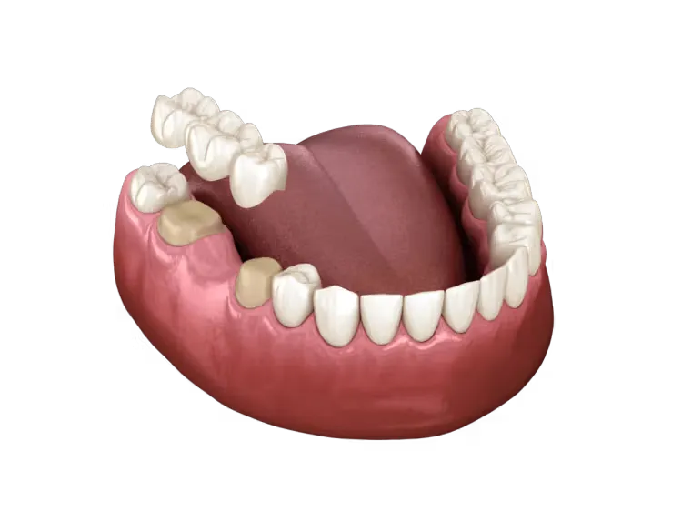 Illustration of a dental bridge replacing a missing tooth